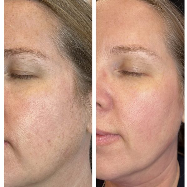 Transformation images of a woman’s skin before and after ADVATx laser treatment for scar removal, located in Omaha.