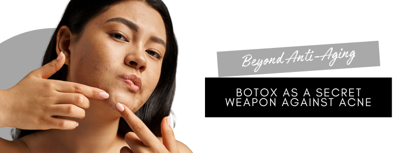 Botox treatment for acne, highlighting its effectiveness in Omaha and La Vista as a secret weapon for clear skin.